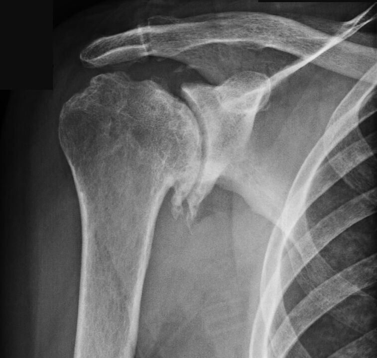 X-ray showed shoulder arthrosis