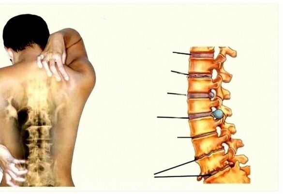 Stages of cervical osteocondrosis