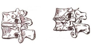 Stages of cervical osteocondrosis