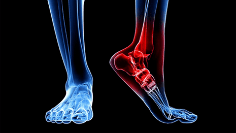 Artrosis of ankle joint