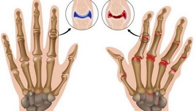 The main differences of arthritis and arthrosis