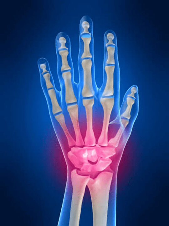 Arthritis of the wrist combination