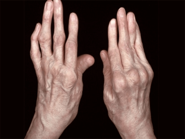 As the cause of pain in the joints of arthritis fingers