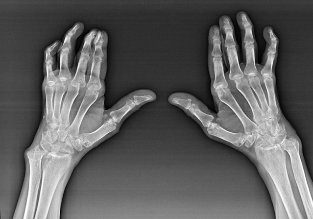 Diagnosis of the joints of fingers