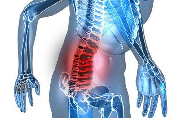 Spine deformation in the fourth stage of lumbar osteochondrosis