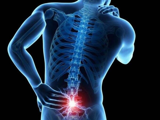 With radiculitis, the nerve roots cause the appearance of sharp pains in the lower back