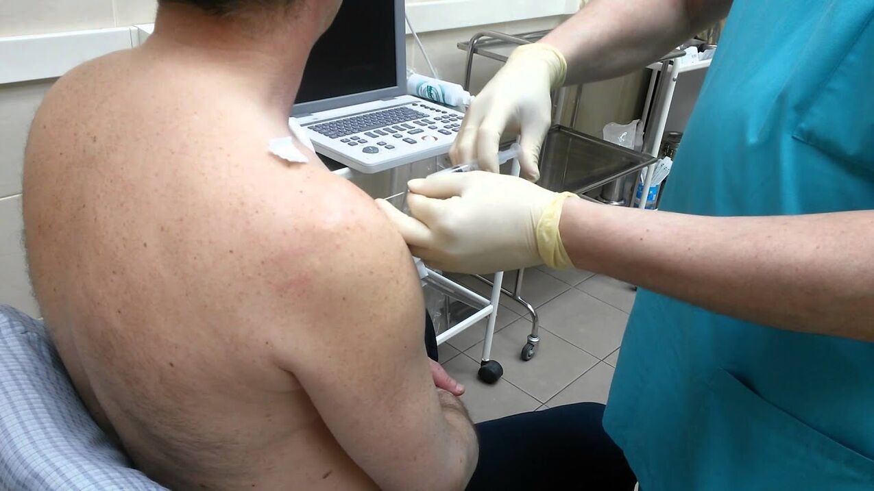 Shoulder injection for arthrosis