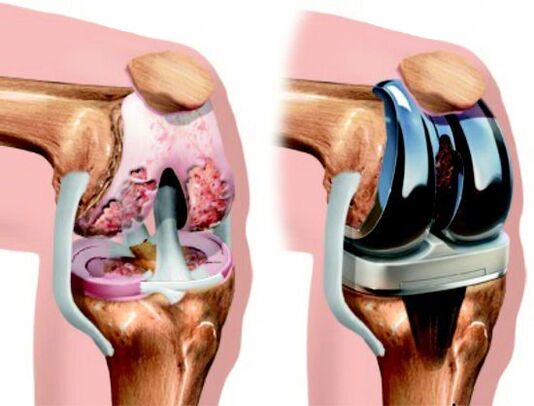 Endoprosthesis replacement is a surgical treatment in which the damaged joint is replaced with a prosthesis.
