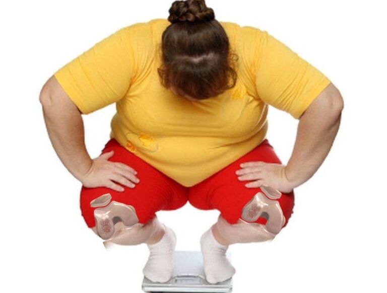 Most patients suffering from arthrosis are overweight or obese