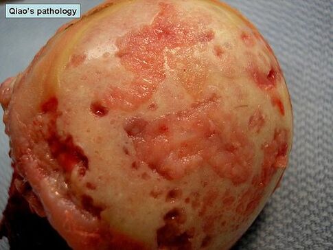 Cartilage surface affected by arthrosis