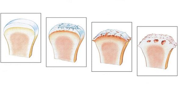Healthy joint and 3 degrees of arthrosis development