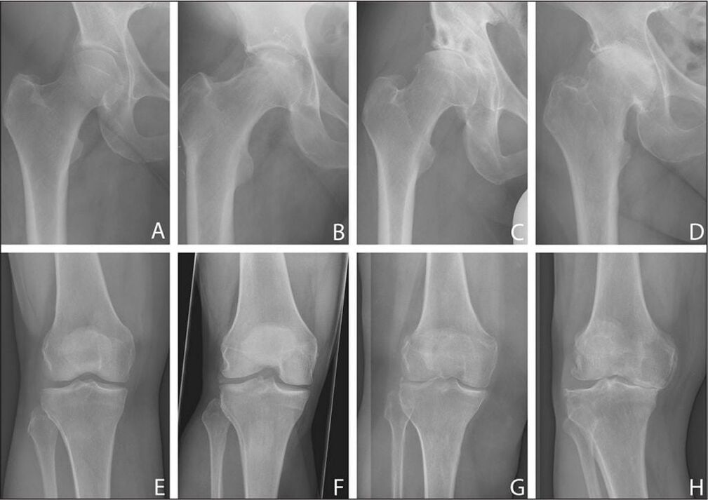 Stages of development of joint arthrosis on X-ray